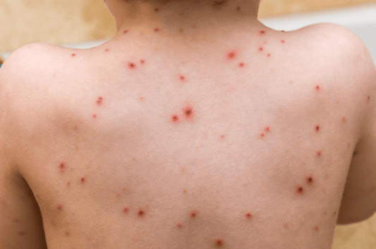 Can Red Light Therapy Treat Herpes Zoster (A.K.A. Shingles)? - Kineon